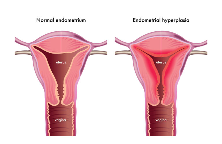 Rahim duvarı kalınlaşması endometrial hiperplazi