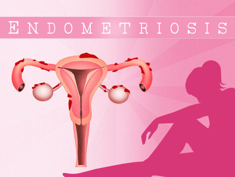 Endometriozis nedir belirtileri tedavisi