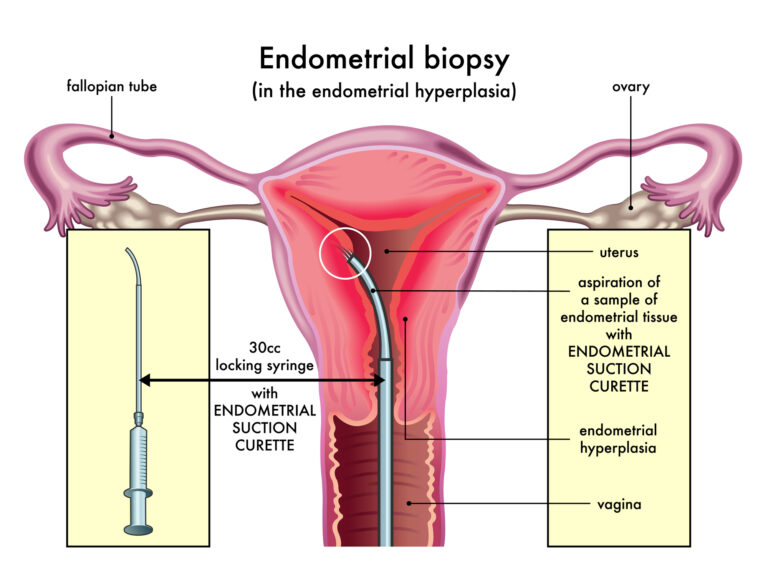 Endometrium biyopsisi rahim içi doku örneği