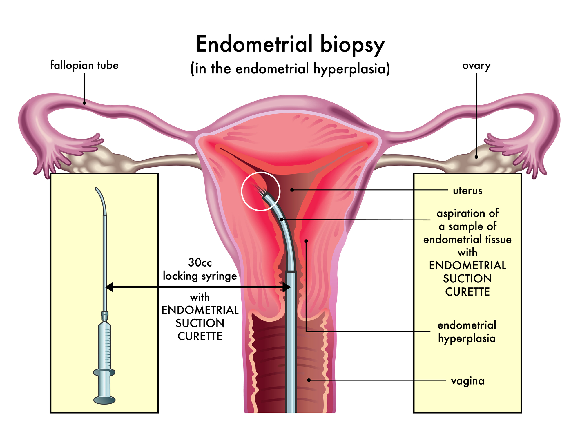 Endometrium biyopsisi rahim içi doku örneği