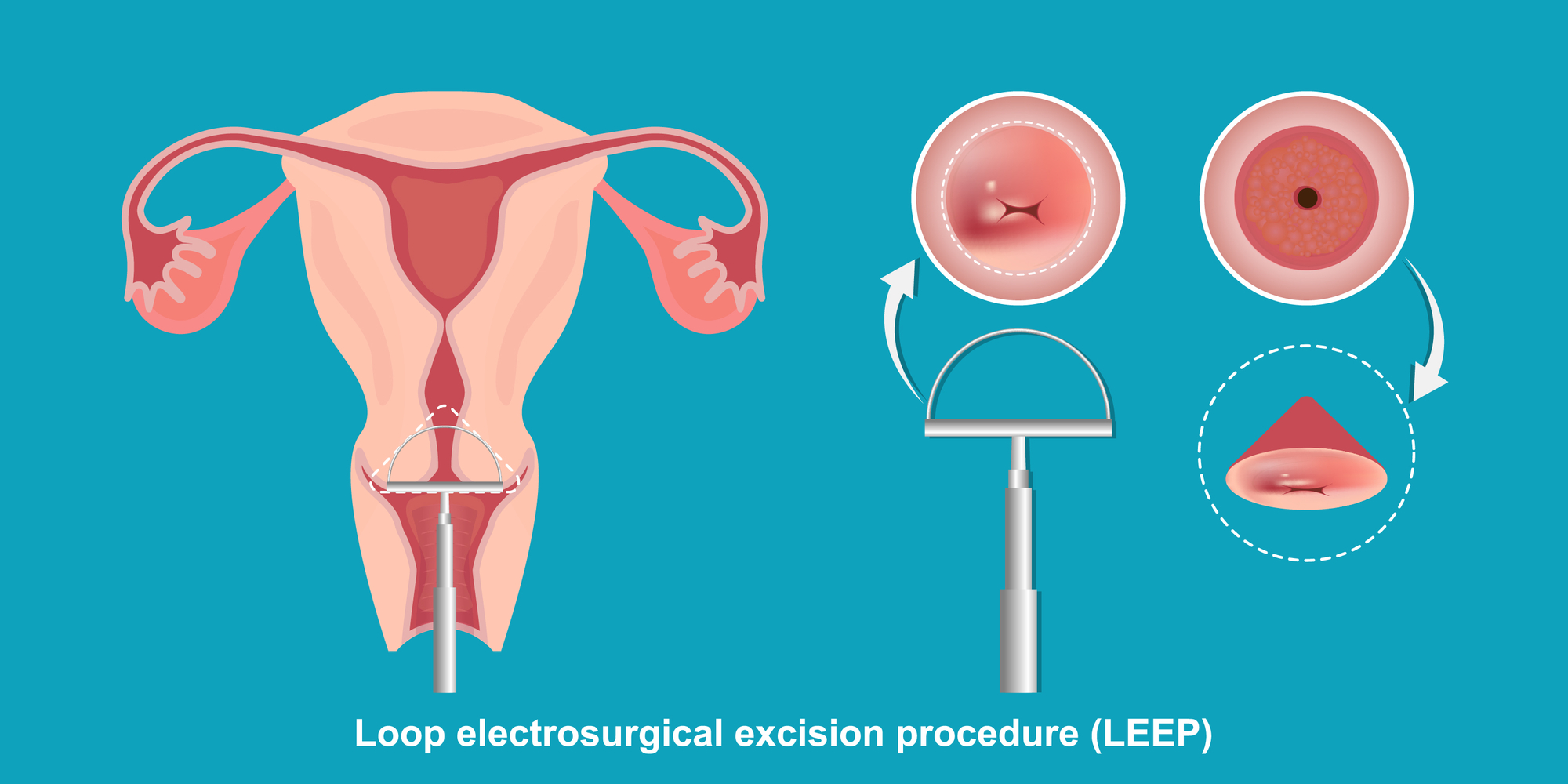 LEEP konizasyon rahim ağzı tedavisi